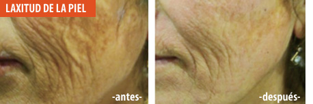 Laxitud de la piel | antes y después