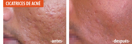 Cicatrices de acn | antes y después