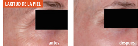 Laxitud de la piel | antes y después